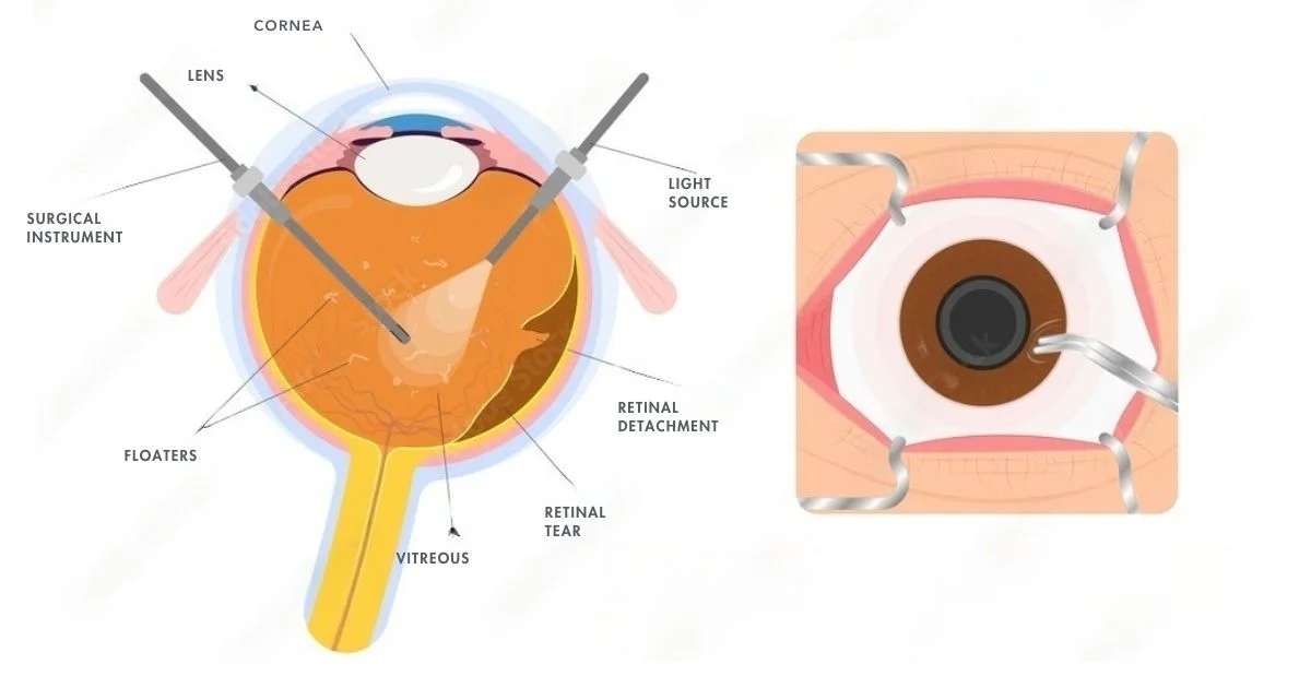 Treatment of Eye Floaters
